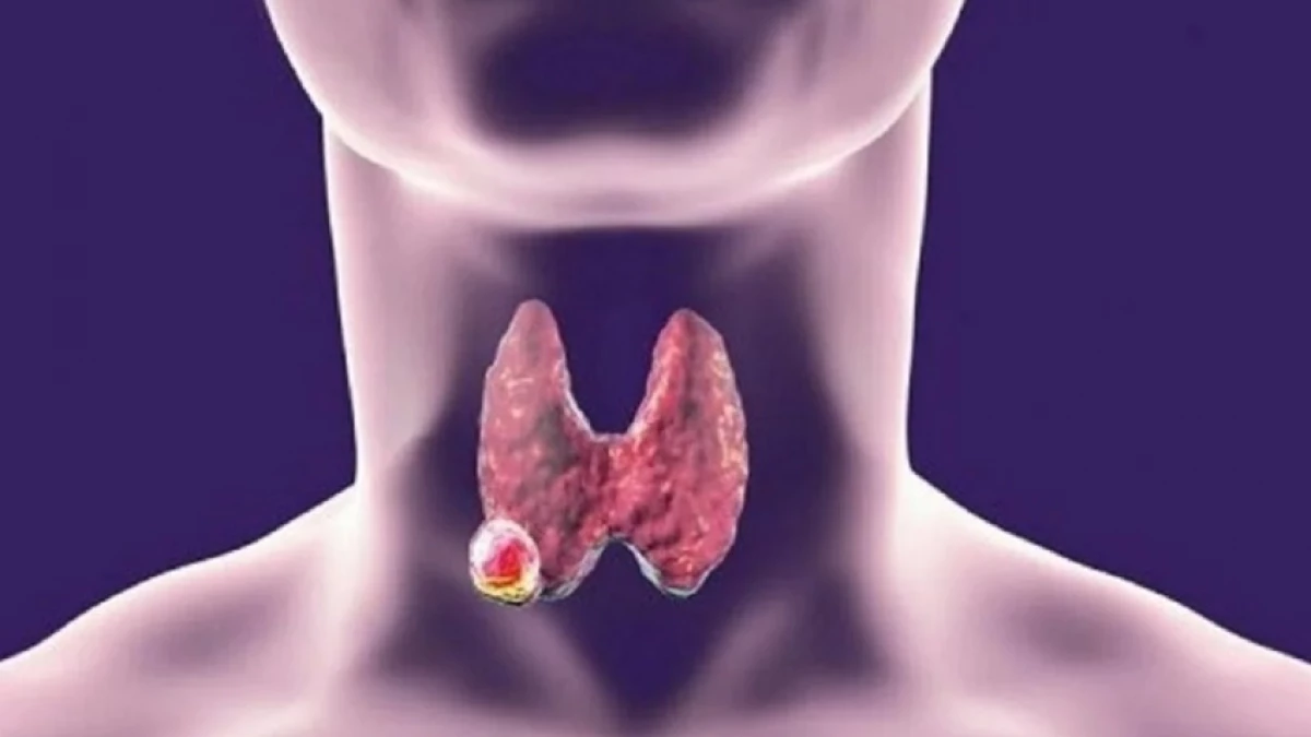 Зоб в горле. Аутоиммунный тиреоидит. Папиллярный зоб щитовидной. Бластома щитовидной железы.