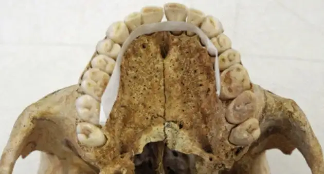 В Великобритании обнаружены средневековые останки со следами проказы и остеосаркомы