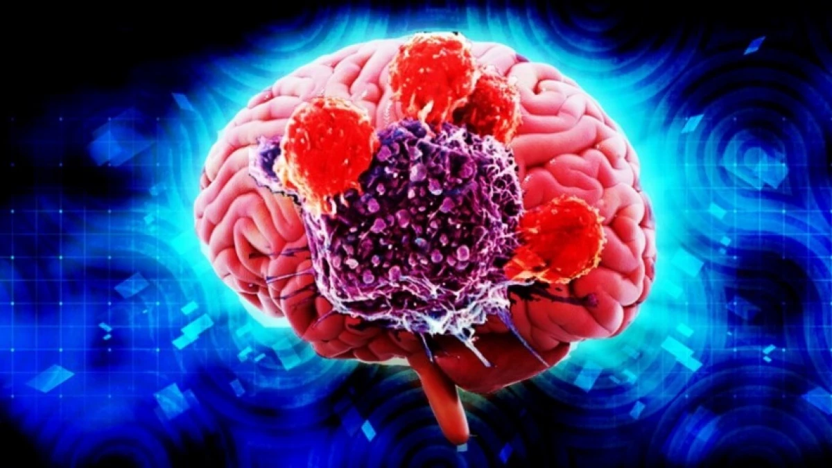 Злокачественное новообразование мозга. Раковые заболевания головного мозга. Злокачественная опухоль головного мозга.